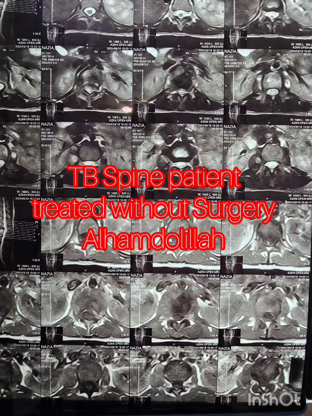 TB Spine Patient Treateb without Surgery  by Dr Muhammad Inam