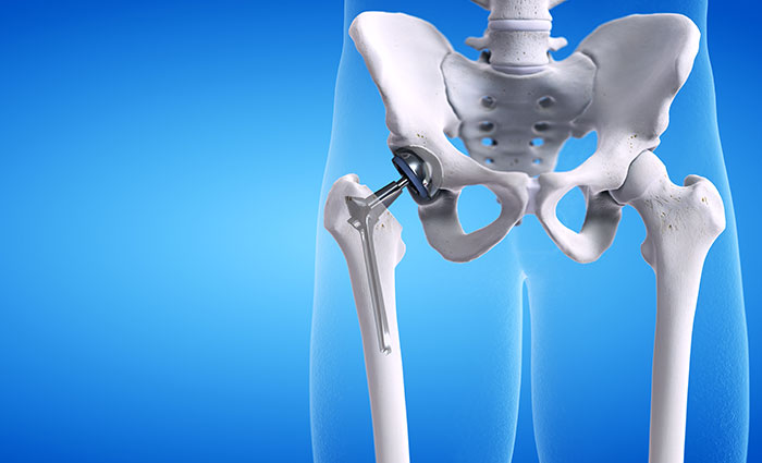 hip pain