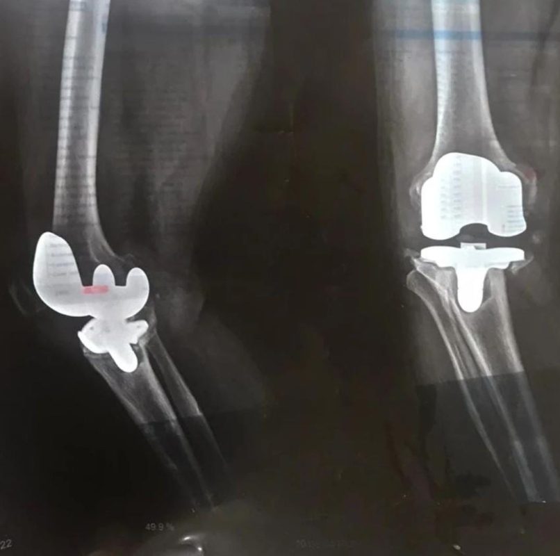 knee pain