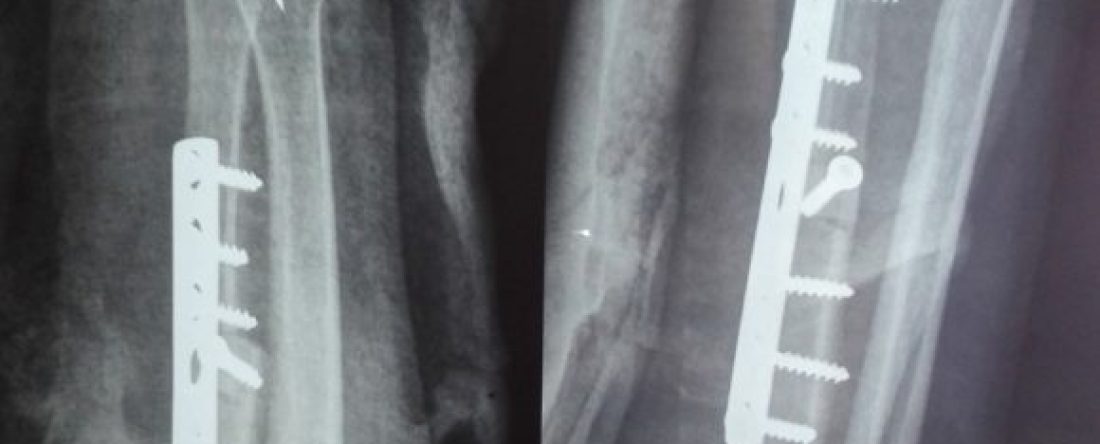 Cancer of Wrist
